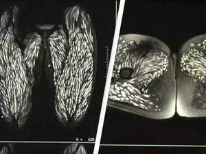 Sering Makan Daging Babi Mentah, Tubuh Wanita Ini Penuh Parasit