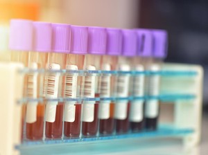 Kemenkes RI Temukan 116 Suspek Mpox, Begini Hasil Pemeriksaannya