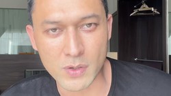 Indra Bruggman Oplas demi Kembalikan Bentuk Mata karena Hipertiroid