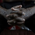 Mpox Menyebar Lagi! Negara Ini Umumkan Darurat, China-Prancis Kena