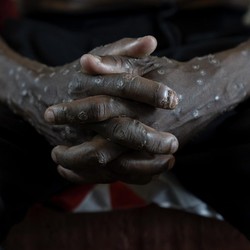 Mpox Menyebar Lagi! Negara Ini Umumkan Darurat, China-Prancis Kena