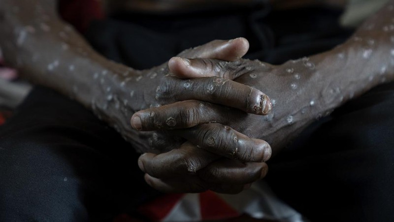 A man suffering from mpox waits for treatment at the Kamituga General Hospital in South Kivu Congo, Wednesday, Sept. 4, 2024. (AP Photo/Moses Sawasawa)