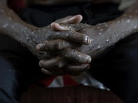 Mpox Menyebar Lagi! Negara Ini Umumkan Darurat, China-Prancis Kena