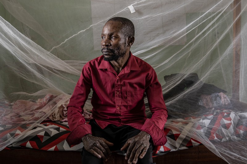 A man suffering from mpox waits for treatment at the Kamituga General Hospital in South Kivu Congo, Wednesday, Sept. 4, 2024. (AP Photo/Moses Sawasawa)