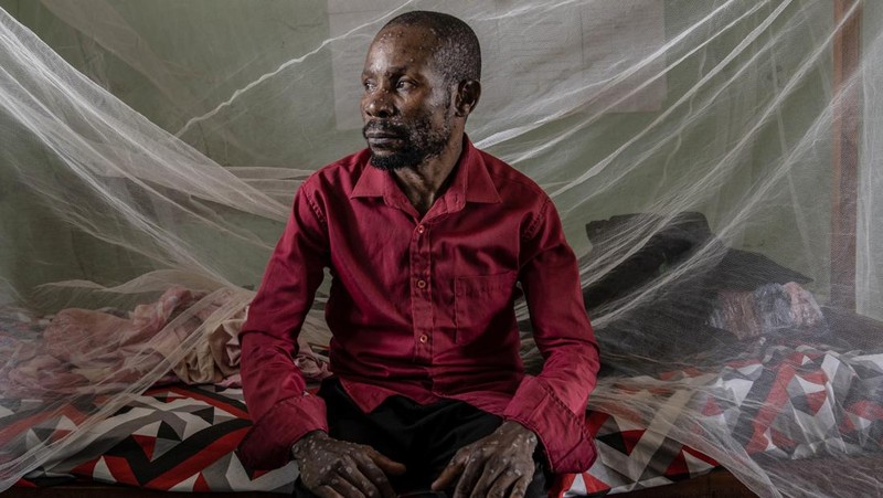 A man suffering from mpox waits for treatment at the Kamituga General Hospital in South Kivu Congo, Wednesday, Sept. 4, 2024. (AP Photo/Moses Sawasawa)