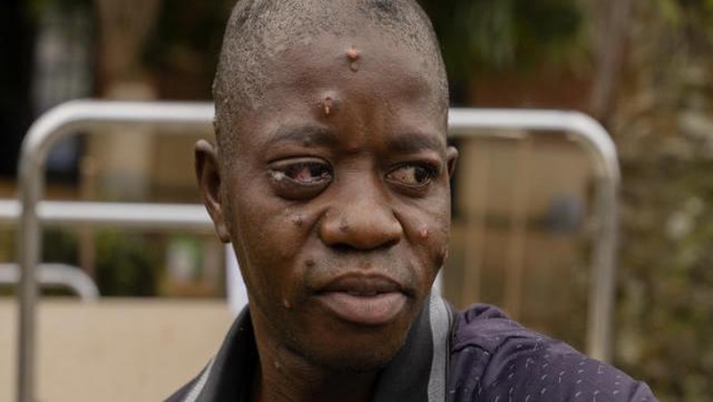 A man suffering from mpox waits for treatment at the Kamituga General Hospital in South Kivu Congo, Wednesday, Sept. 4, 2024. (AP Photo/Moses Sawasawa)