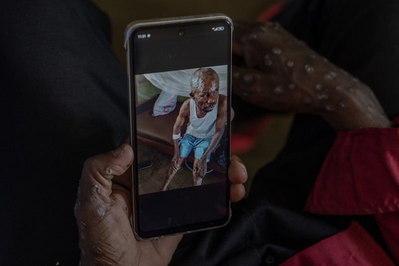A man suffering from mpox waits for treatment at the Kamituga General Hospital in South Kivu Congo, Wednesday, Sept. 4, 2024. (AP Photo/Moses Sawasawa)