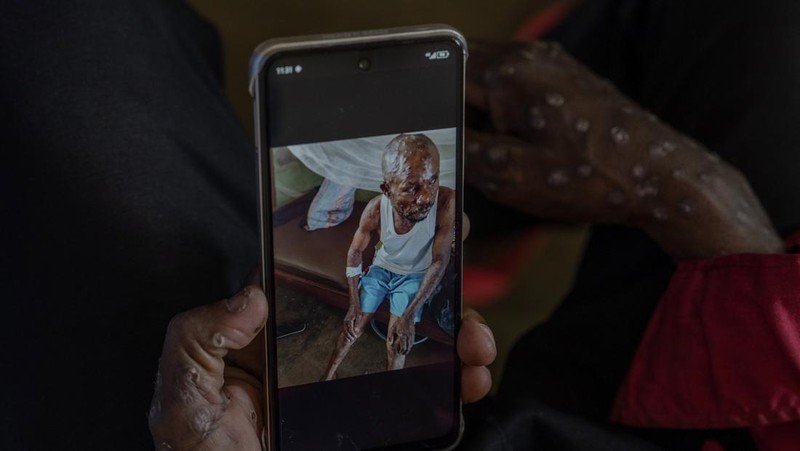 A man suffering from mpox waits for treatment at the Kamituga General Hospital in South Kivu Congo, Wednesday, Sept. 4, 2024. (AP Photo/Moses Sawasawa)