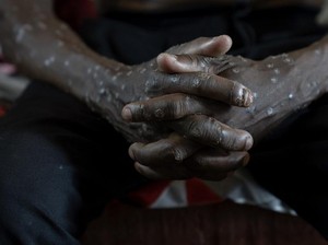 Makin Melonjak! Kasus Mpox di Afrika Nyaris Tembus 30 Ribu Kasus