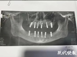 Berkaca Kasus Viral Pria China, Ini Saran Dokter Biar Cabut Gigi Tak Berujung Fatal