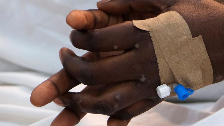 Pihak berwenang di Republik Demokratik Kongo kedatangan pertama vaksin cacar monyet di ibu kota Kinshasa, tiga minggu setelah Badan Kesehatan Dunia (WHO) menyatakan wabah mpox di 12 negara Afrika sebagai keadaan darurat global. (REUTERS/Justin Makangara)