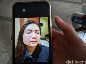 Selebgram Dwita Qorina Diduga Dianiaya Mantan Suami Siri hingga Babak Belur