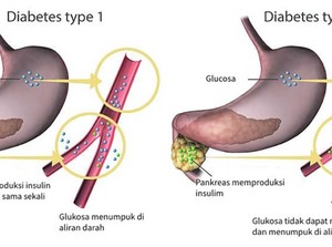 Glucoformin Obat Herbal Bantu Turunkan Kadar Gula Darah Diabetes
