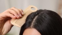 Ketombe Nggak Kunjung Hilang Meski Rajin Keramas? Mungkin Shampoo Kamu yang Salah