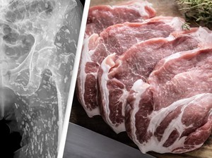 Dokter Ini Ungkap Kondisi Tubuh Orang yang Doyan Daging Babi Mentah