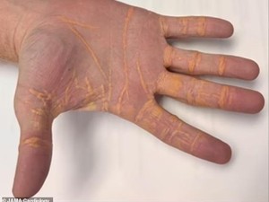 Kacau! 5 Orang Ini Alami Efek Samping Ekstrem Usai Terlalu Banyak Makan