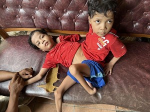 Kisah Kembar Siam Hidup dengan Perut Menyatu, Tetap Tegar Terima Takdir
