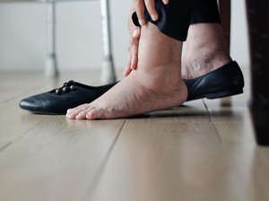 Kaki Sering Bengkak? Coba 7 Makanan Ini untuk Bantu Jaga Sirkulasi Darah