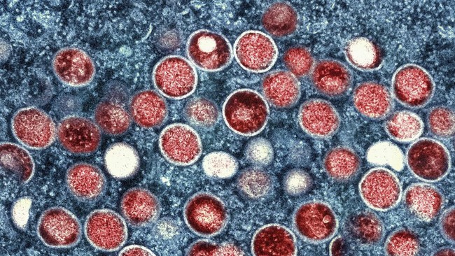 5 Pria Positif Monkeypox usai Kunjungi Sauna Khusus Gay
