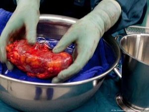 Jual Ginjal, Mengungkap Jaringan Perdagangan Organ Global