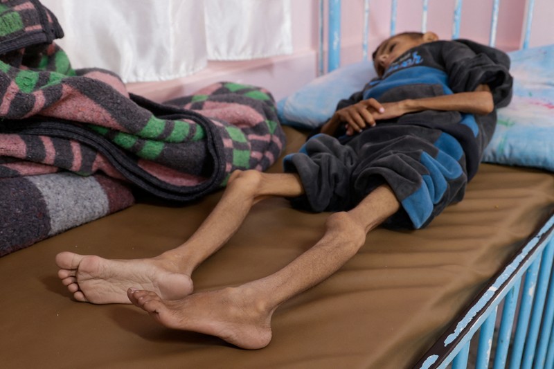 Anak Palestina Osama Al-Reqep, 5 tahun, terbaring di ranjang di Rumah Sakit Nasser tempat ia menerima perawatan, di Khan Younis, di Jalur Gaza selatan, 1 Mei 2025. (REUTERS/Hatem Khaled)