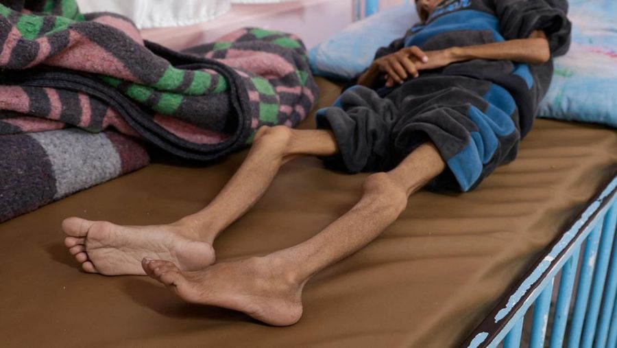 Anak Palestina Osama Al-Reqep, 5 tahun, terbaring di ranjang di Rumah Sakit Nasser tempat ia menerima perawatan, di Khan Younis, di Jalur Gaza selatan, 1 Mei 2025. (REUTERS/Hatem Khaled) Anak Palestina Osama Al-Reqep, 5 tahun, terbaring di ranjang di Rumah Sakit Nasser tempat ia menerima perawatan, di Khan Younis, di Jalur Gaza selatan, 1 Mei 2025. (REUTERS/Hatem Khaled)