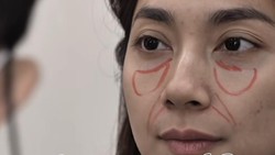 8 Foto Dinda Kirana Oplas Wajah Hingga Payudara di Korea, Jadi Makin Cantik