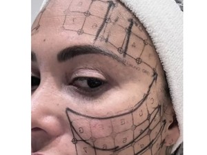 Influencer Habiskan Rp 1,6 M Demi Cantik Usai Melahirkan, Oplas Hingga Botox