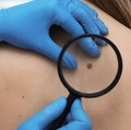 Kenali Neurofibromatosis Tipe 1, Penyakit Langka Serang Jaringan Saraf