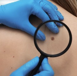 Kenali Neurofibromatosis Tipe 1, Penyakit Langka Serang Jaringan Saraf