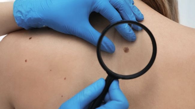 Kenali Neurofibromatosis Tipe 1, Penyakit Langka Serang Jaringan Saraf