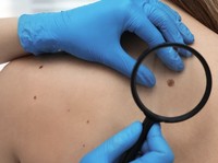 Kenali Neurofibromatosis Tipe 1, Penyakit Langka Serang Jaringan Saraf