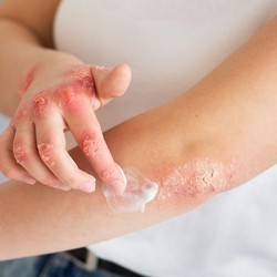 Kulit Sensitif Bisa Diturunkan dari Nenek, Bukan Cuma Ibu atau Ayah