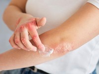Kulit Sensitif Bisa Diturunkan dari Nenek, Bukan Cuma Ibu atau Ayah