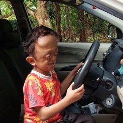 Ketabahan Si Kecil Aufan Penderita Hidrosefalus hingga Sindrom Crouzon