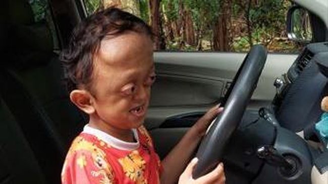 Ketabahan Si Kecil Aufan Penderita Hidrosefalus hingga Sindrom Crouzon