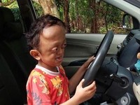 Ketabahan Si Kecil Aufan Penderita Hidrosefalus hingga Sindrom Crouzon