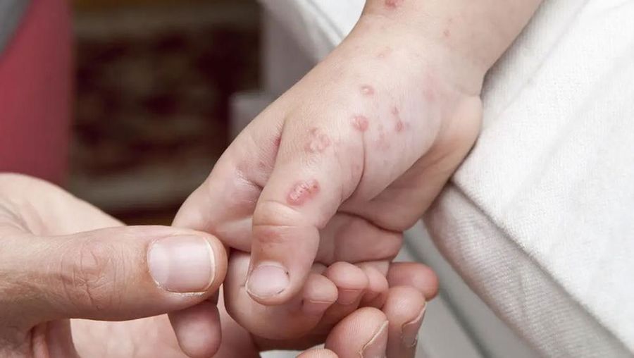 Penyakit Cacar Api atau Herpes Zoster. (Dok. satgasimunisasipapdi)