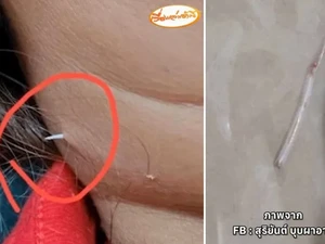 Wanita Ini Tersedak Duri Ikan Sampai Menembus Kulit Lehernya