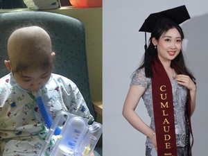 Kisah Inspiratif Michelle, Penyintas Kanker Darah yang Kini Jadi Psikolog