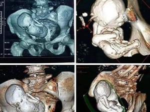 Viral CT Scan Bayi yang Membatu di Perut Wanita, Sudah Ada Selama 30 Tahun!