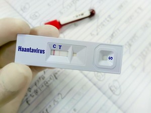 Apa Itu Virus Hanta yang Menyebar di Indonesia? Ini Gejalanya