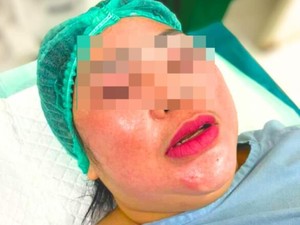 Ibu-Anak di Tarakan Jadi Korban Layangan, Biaya Pengobatan Capai Rp 3 Juta