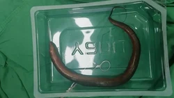 Ngilu! Dokter Temukan Belut Hidup Sepanjang 30 Cm Berenang di Perut Pria Ini