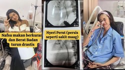 Wanita Samarinda Kena Kanker Saluran Empedu Stadium 4 di Usia 38, Inikah Pemicunya?