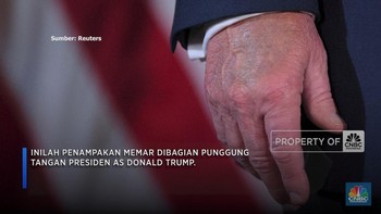 Trump Alami Masalah Pembuluh Darah, Ini Tanda-tandanya