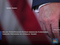 Trump Alami Masalah Pembuluh Darah, Ini Tanda-tandanya
