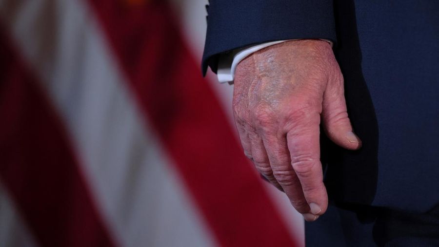  Make-up partially covers the back of the right hand of U.S. President Donald Trump as he speaks to members of the media upon his arrival from Pennsylvania, at Joint Base Andrews, Maryland, U.S., July 15, 2025. In a July 17, 2025 press briefing, U.S. Press Secretary Karoline Leavitt read a statement from his doctor that President Trump has a chronic venous insufficiency