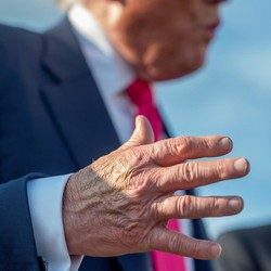 Penampakan Kondisi Trump: Tangan Memar-Kaki Bengkak, Ada Penyakit Ini