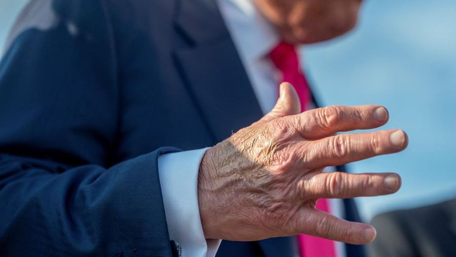  Make-up partially covers the back of the right hand of U.S. President Donald Trump as he speaks to members of the media upon his arrival from Pennsylvania, at Joint Base Andrews, Maryland, U.S., July 15, 2025. In a July 17, 2025 press briefing, U.S. Press Secretary Karoline Leavitt read a statement from his doctor that President Trump has a chronic venous insufficiency